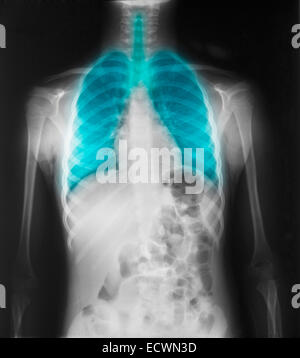 normal chest x-ray of a 3 year old boy Stock Photo - Alamy