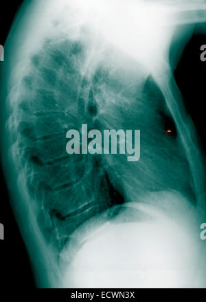 Chest x-ray showing a small metal foreign body. Stock Photo