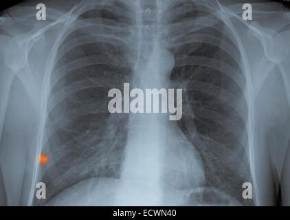 Chest x-ray showing a small metal foreign body. Stock Photo