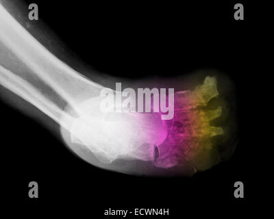 x-ray showing osteomyelitis of the foot in a diabetic woman. Stock Photo