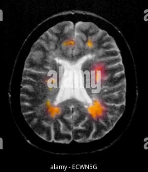 Brain MRI showing multiple sclerosis. 36 year old female Stock Photo