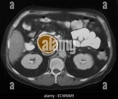Pancreatic pseudocyst seen on MRI. Stock Photo