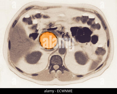 Pancreatic pseudocyst seen on MRI. Stock Photo
