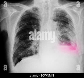 Chest x-ray showing a lung infiltrate of pneumonia Stock Photo - Alamy