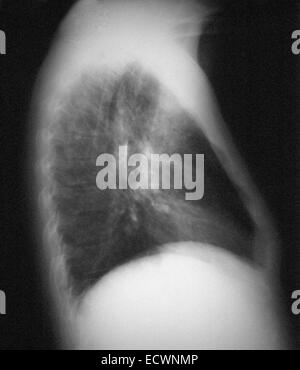 AIDS patient with pneumocystis carinii pneumonia. Stock Photo