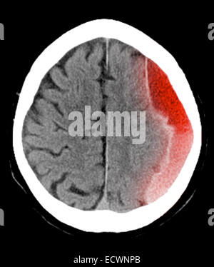 CT scan of the head showing a subdural hematoma. Stock Photo
