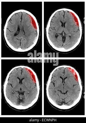 CT scan showing a large left subdural hematoma. Stock Photo