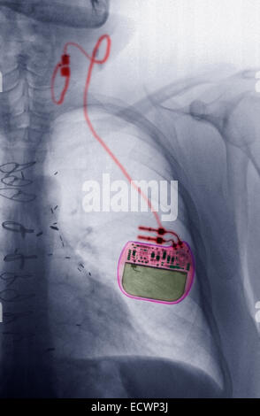 Chest x-ray showing a vagus nerve stimulator for epilepsy. Stock Photo