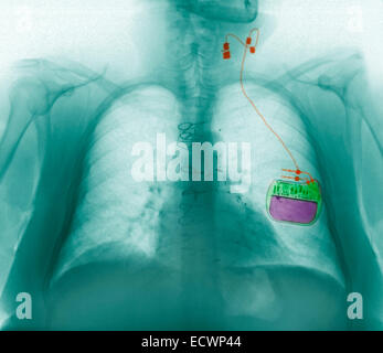 Chest x-ray showing a vagus nerve stimulator for epilepsy. Stock Photo