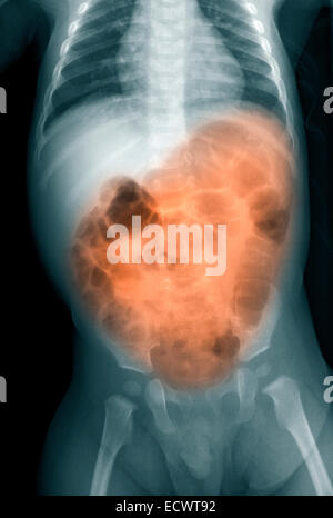 X-ray of a 7 month old boy with vomiting and diarrhea. Stock Photo