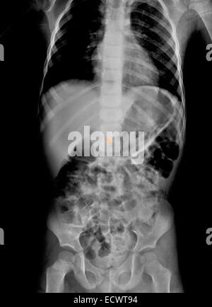 Abdomen x-ray of a boy who swallowed a small metal bead. Stock Photo
