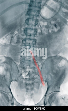 X-ray Showing An Aorto-iliac Wire-mesh Bypass Graft Stock Photo - Alamy