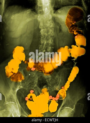 X-ray with barium contrast showing diverticulosis. Stock Photo