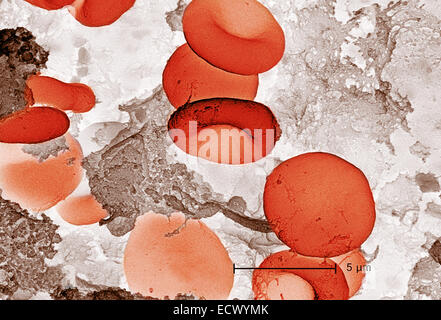 Scanning electron micrograph of red blood cells and fibrin.