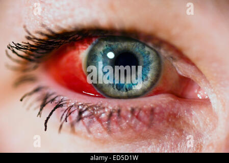 Woman's eye with broken Blood Vessel (subconjunctival hemorrhage) Stock Photo