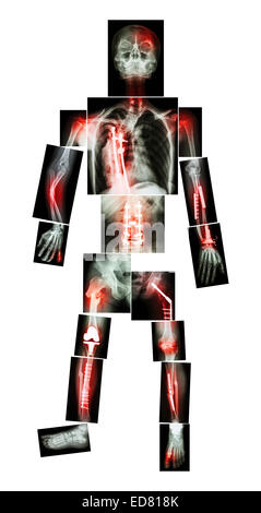 X-ray whole body and multiple fracture. He was operated and internal fixation by plate & screw Stock Photo