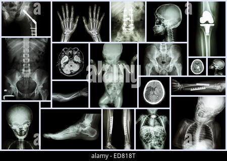Collection X-ray Multiple adult and child's organ & orthopedic surgery & multiple disease (Stroke , Osteoarthritis knee , Fractu Stock Photo