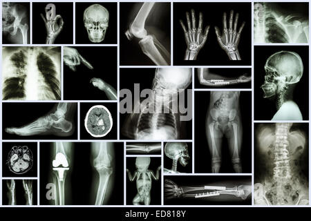 Collection X-ray multiple part of human & Orthopedic surgery & Multiple disease (Osteoarthritis knee,spondylosis,Stroke,Fracture Stock Photo