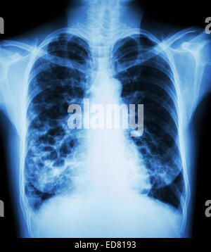 'Bronchiectasis'  X-ray chest show : multiple lung bleb and cyst due to chronic infection Stock Photo