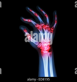 'Rheumatoid Arthritis , Gouty Arthritis'  (X-ray adult's hand with multiple arthritis) Stock Photo