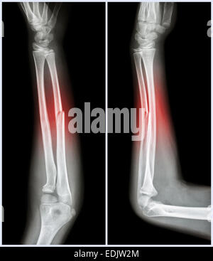 Fracture shaft of ulnar bone ( forearm bone ) : ( Left : pre-treatment ...