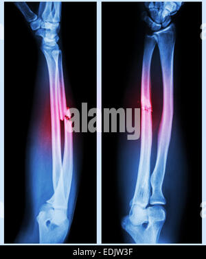 X-ray forearm ( front , side ) : Comminuted fracture shaft of ulnar ...