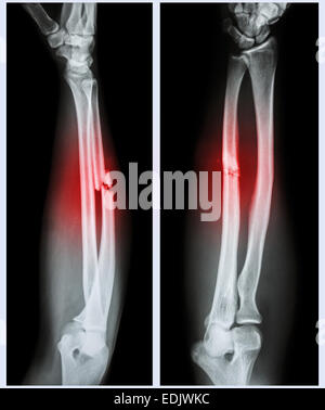 X-ray forearm ( front , side ) : Comminuted fracture shaft of ulnar ...