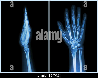 X-Ray Hands ( front & side view ) : Normal human hands Stock Photo - Alamy