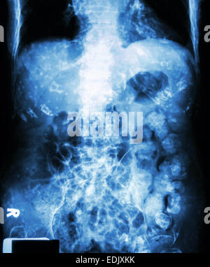 ' Constipation '   ( X-ray abdomen of old man : a lot of feces in large bowel and calcified at rib ) Stock Photo