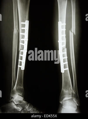 film x-ray ankle AP/Lateral : show fracture distal tibia and fibula ...