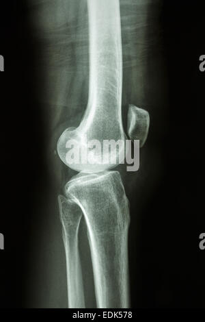 Flim X-ray knee lateral : show normal human's knee joint Stock Photo