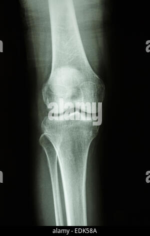 Flim X-ray knee AP : show normal human's knee joint Stock Photo