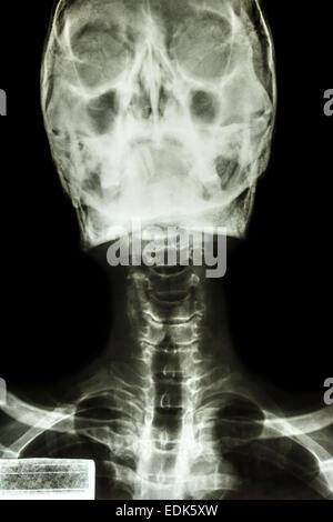 Film x-ray show normal human's skull and cervical spine Stock Photo