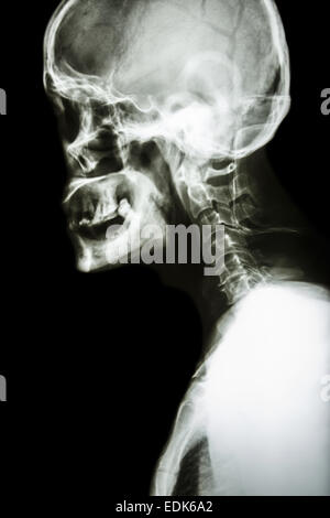 Film x-ray Skull lateral : show normal human's skull and cervical spine Stock Photo
