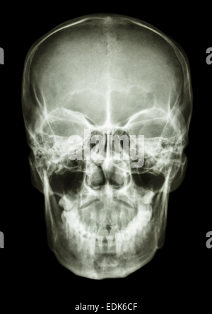 film x-ray skull AP : show normal human's skull Stock Photo