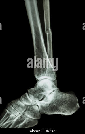 film x-ray ankle lateral : show complete fracture shaft of fibula (leg's bone) Stock Photo