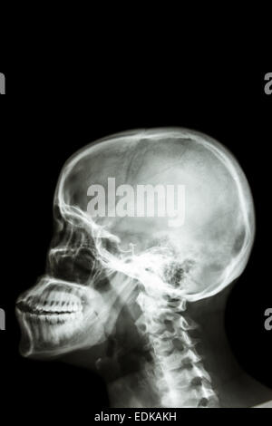 film x-ray skull lateral : show human's skull and blank area at upper side for fill text Stock Photo