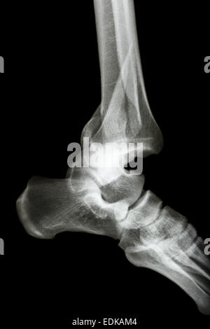 film x-ray ankle AP/Lateral : show fracture tibia & fibula (leg's bone) and ankle dislocation Stock Photo