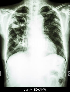 film chest x-ray show cavity at right upper lung due to Mycobacterium tuberculosis infection (Pulmonary Tuberculosis) Stock Photo