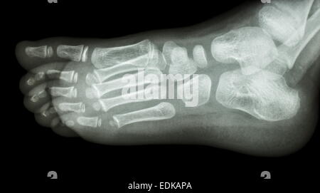 film x-ray foot lateral : show normal child's foot Stock Photo