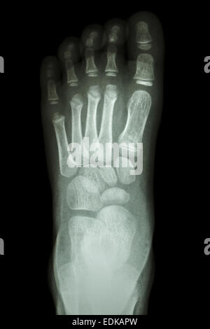 film x-ray foot AP : show normal child's foot Stock Photo