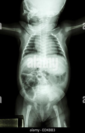 film x-ray whole infant's body : show normal infant's body Stock Photo