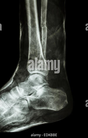 film x-ray fracture shaft of fibula(leg's bone) with cast Stock Photo