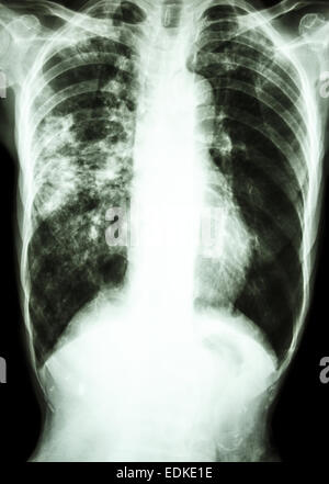 film chest x-ray show alveolar infiltrate at right lung due to Mycobacterium tuberculosis infection (Pulmonary Tuberculosis) Stock Photo