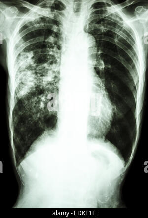 film chest x-ray show alveolar infiltrate at right lung due to ...