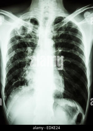 film chest x-ray show cavity at right upper lung due to Mycobacterium tuberculosis infection (Pulmonary Tuberculosis) Stock Photo