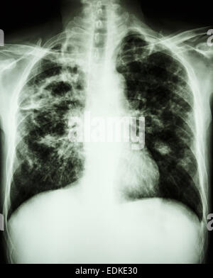 film chest x-ray show cavity at right lung,fibrosis & interstitial & patchy infiltrate at both lung due to Mycobacterium tubercu Stock Photo