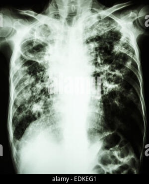 film chest x-ray show cavity at right lung,fibrosis & interstitial & patchy infiltrate at both lung due to Mycobacterium tubercu Stock Photo