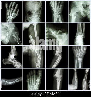 Collection X-ray multiple bone fracture (finger,spine,wrist,hip,leg ...