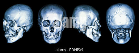 CT scan of human skull and 3D Stock Photo